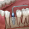 Immediate Implant Surgery