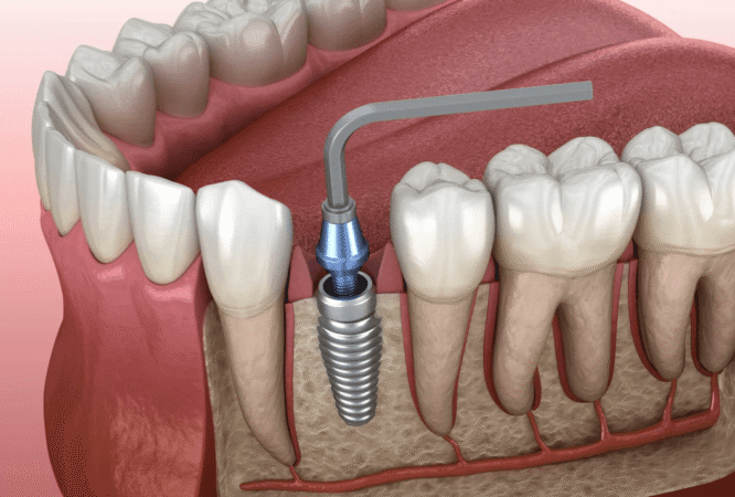 Immediate Implant Surgery