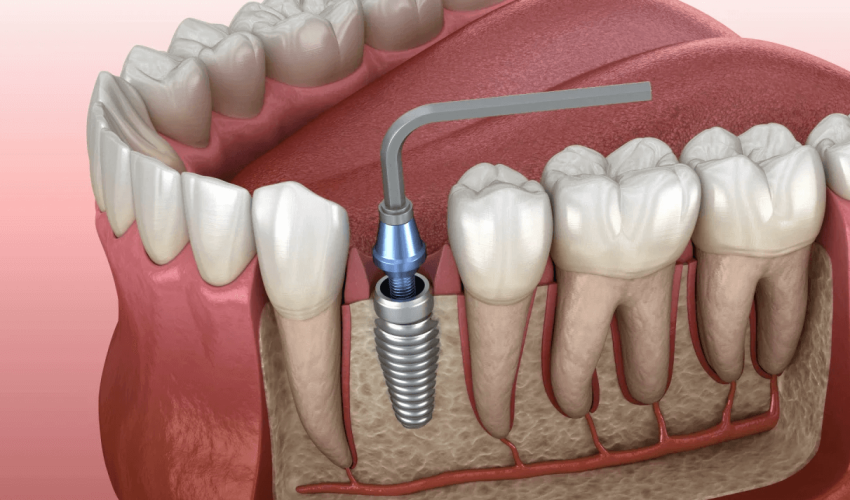 Immediate Implant Surgery